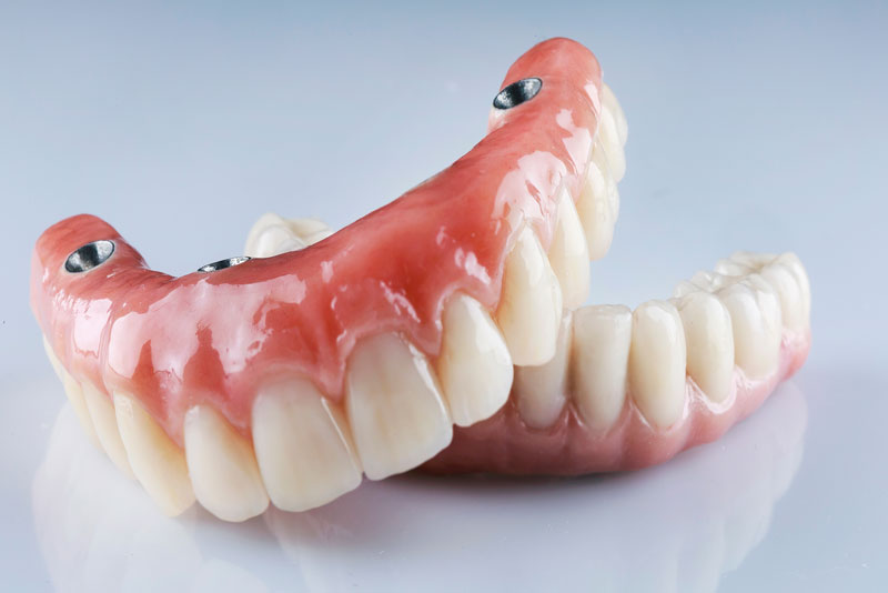 image of a top and lower arch full mouth dental implant model with the dental implants showing in the gum line