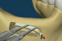 1-INFERIOR-MANDIBULAR-NERVE-LATERALIZATION-300×196 1-INFERIOR-MANDIBULAR-NERVE-LATERALIZATION-300x196