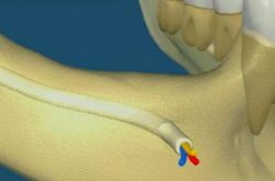 2-INFERIOR-MANDIBULAR-NERVE-LATERALIZATION-e1506624856495 2-INFERIOR-MANDIBULAR-NERVE-LATERALIZATION-e1506624856495