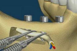 3-INFERIOR-MANDIBULAR-NERVE-LATERALIZATION-300×198 3-INFERIOR-MANDIBULAR-NERVE-LATERALIZATION-300x198