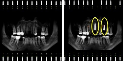 X ray before image IPC X ray before image IPC