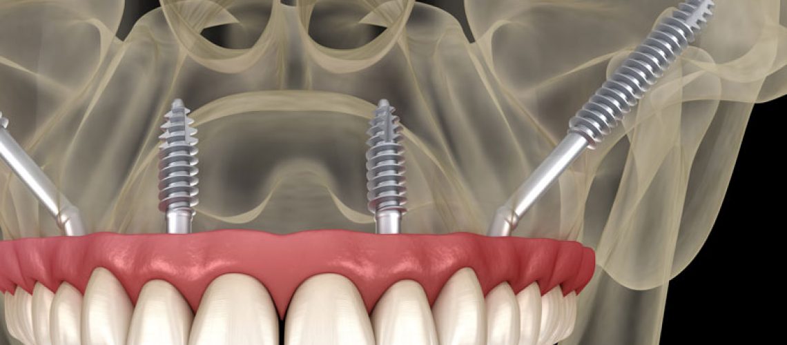 Zygomatic Implants
