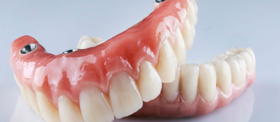 image of a top and lower arch full mouth dental implant model with the dental implants showing in the gum line