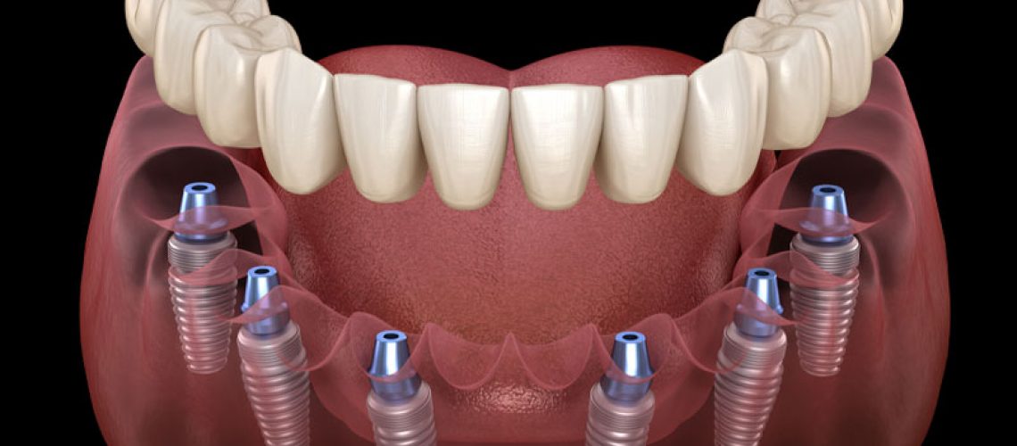 All On Six Dental Implants, Bottom Arch